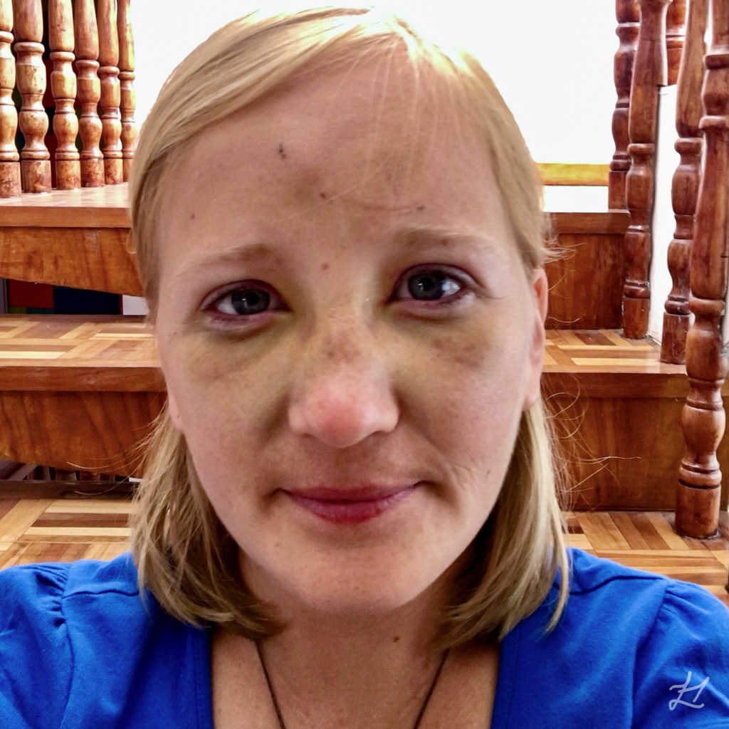 My bruised broken face in Quito, Ecuador