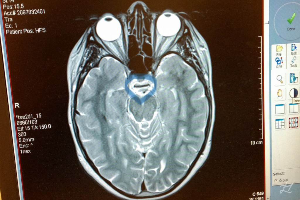 In the blue outline, the pituitary gland is meant to occupy more of that space. But mine has atrophied and is just the black line you see
