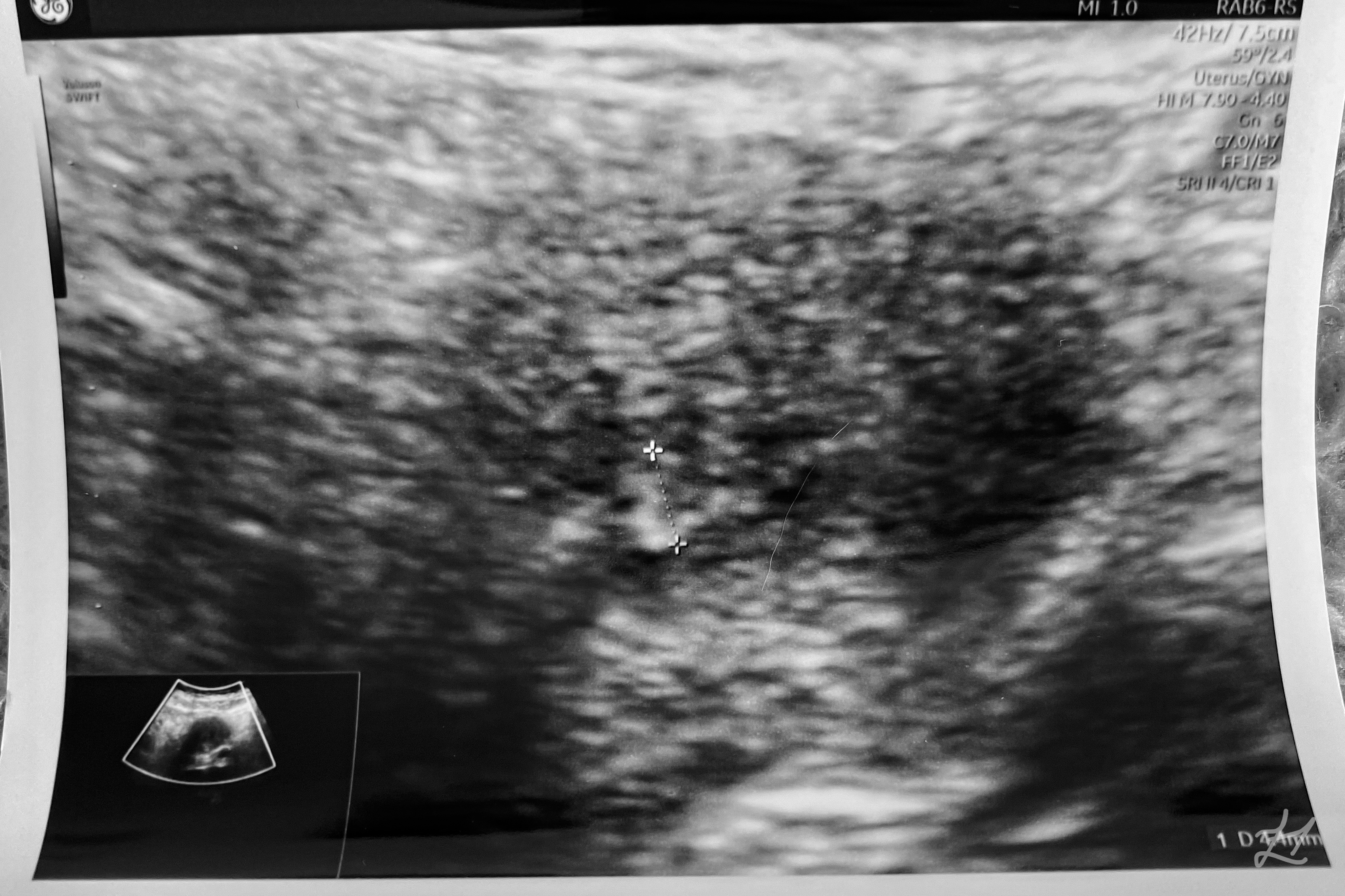 My Endometrial Lining Ultrasound Scan
