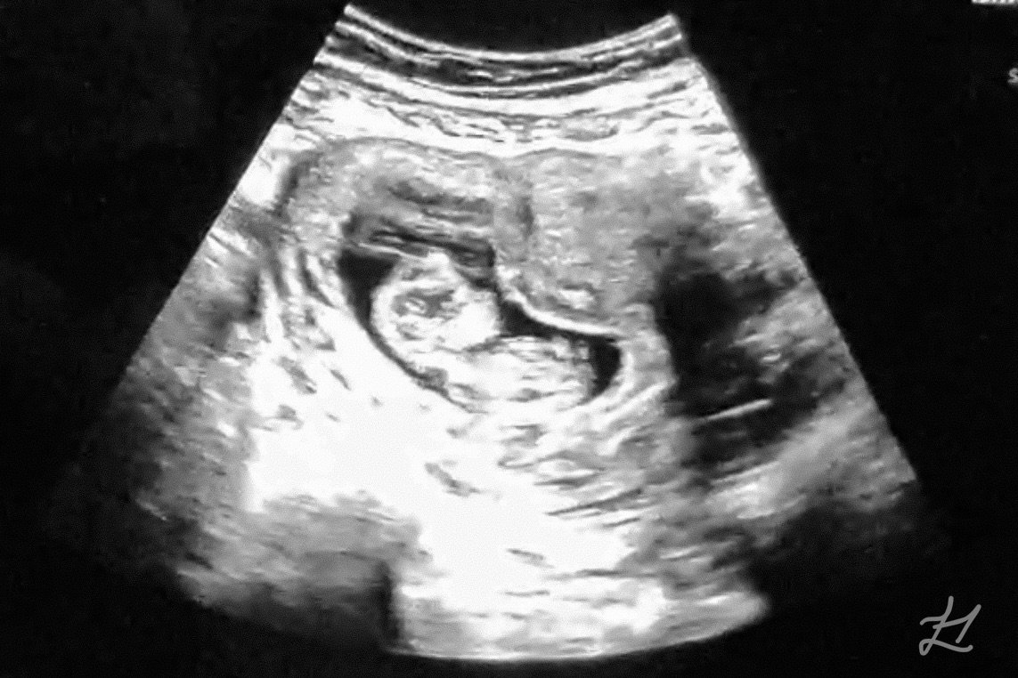 9 week DEIVF baby growing