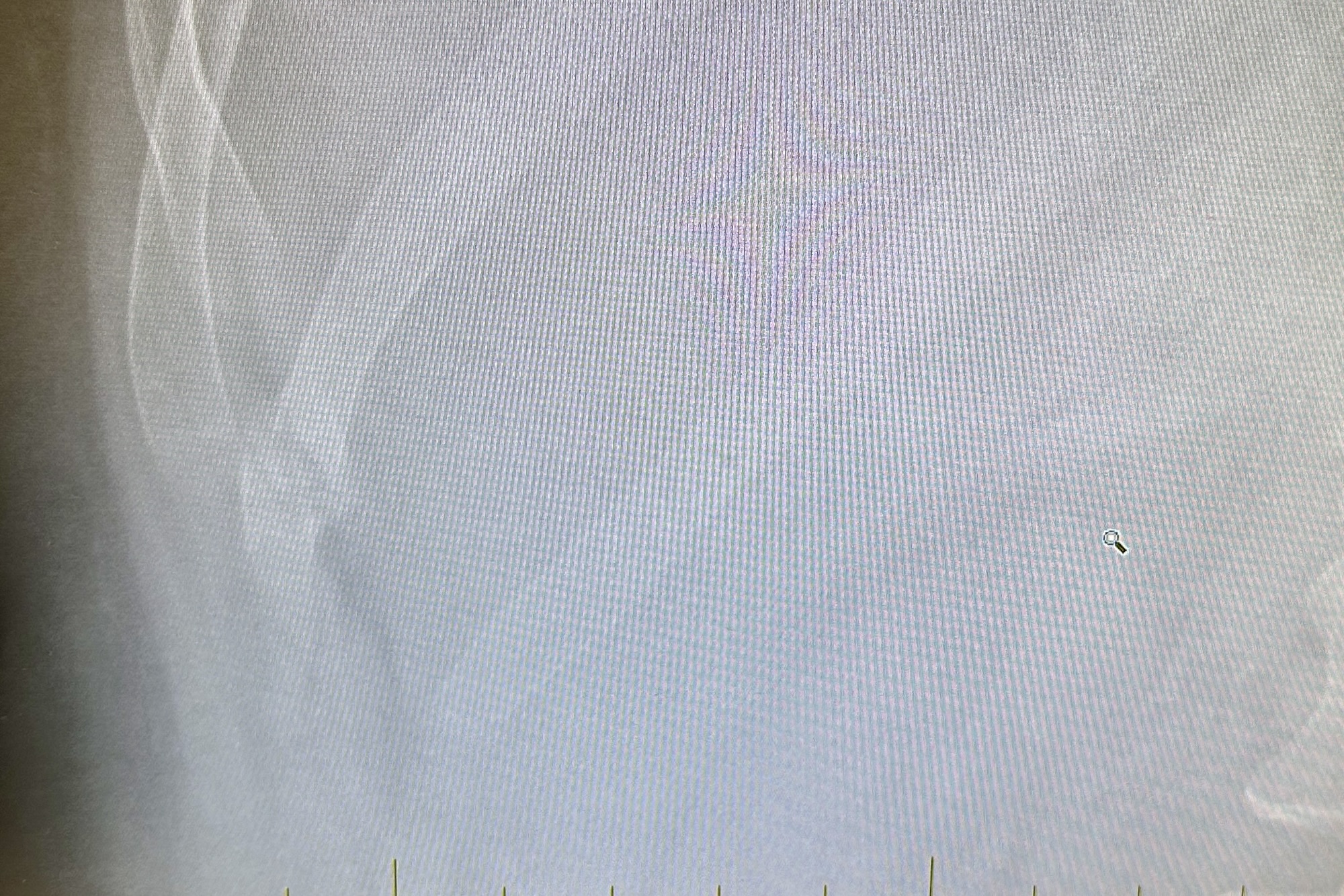 My broken rib bone in May